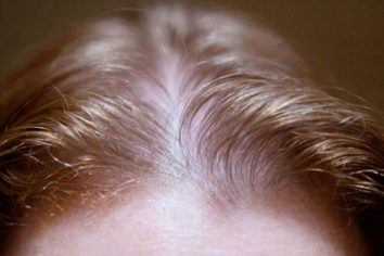 How to Fix Hair Thinning And Hair Fall
