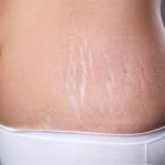 How to Reduce or Remove Stretch Marks